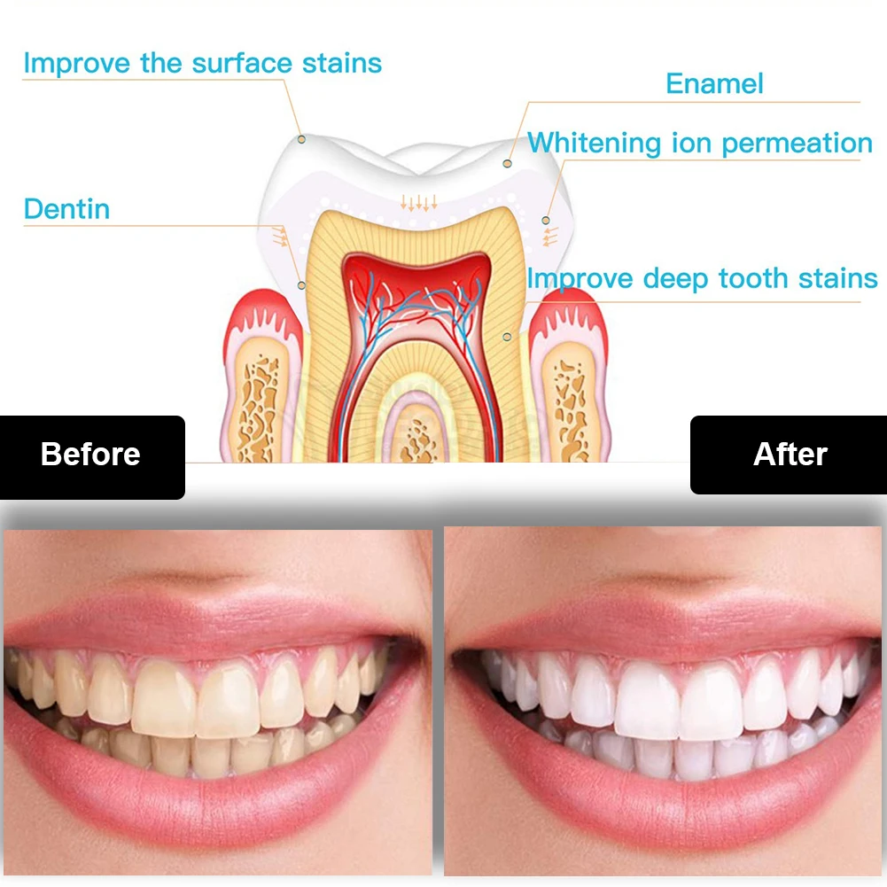 Dental Teeth Whitening Kit Min - Teeth Whitening With Blue Light recension och pris