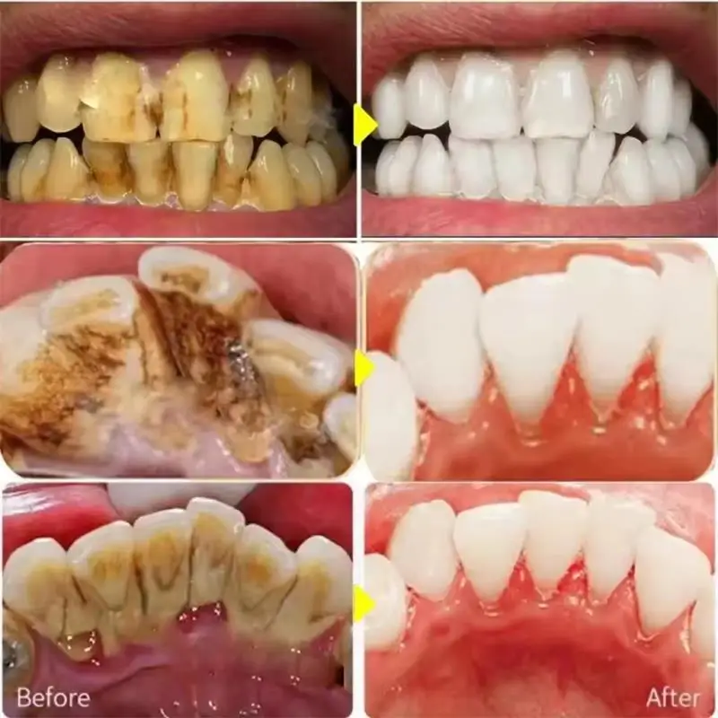Fast Teeth Whtening Toothpaste - Whitening Pen Bleach recension och pris