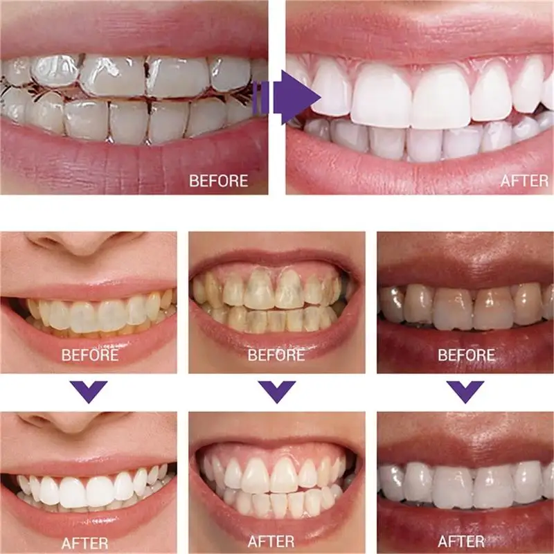 Fast Teeth Whtening Toothpaste - Whitening Pen Bleach recension och pris